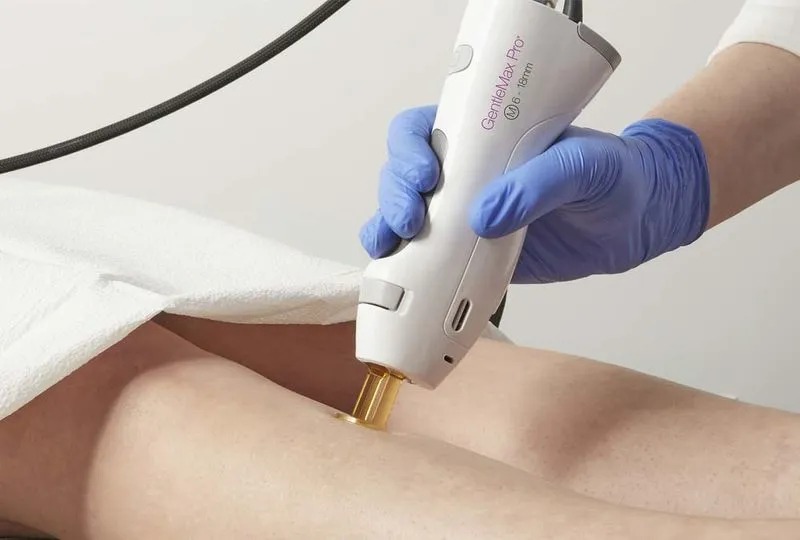 Cooling Laser Hair Removal