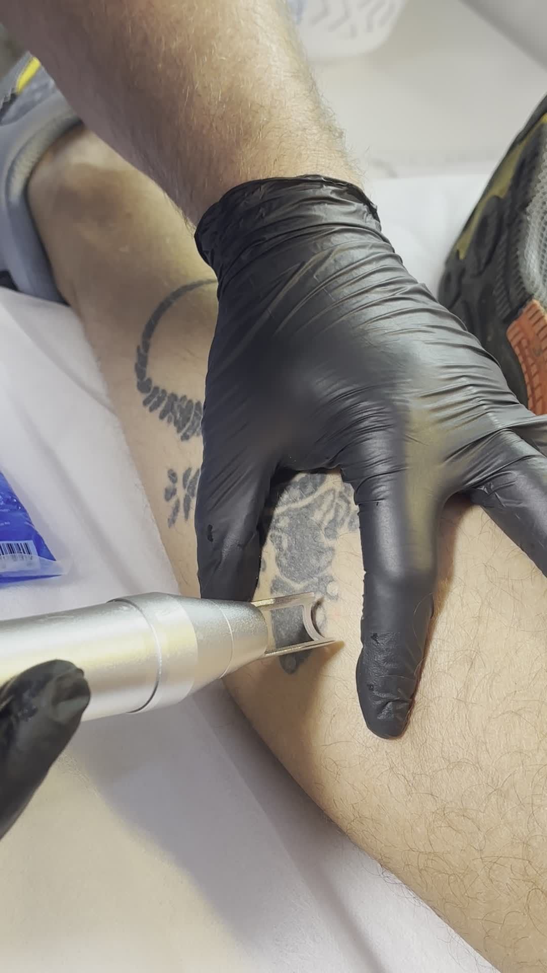 Non-Invasive Laser Tattoo Removal