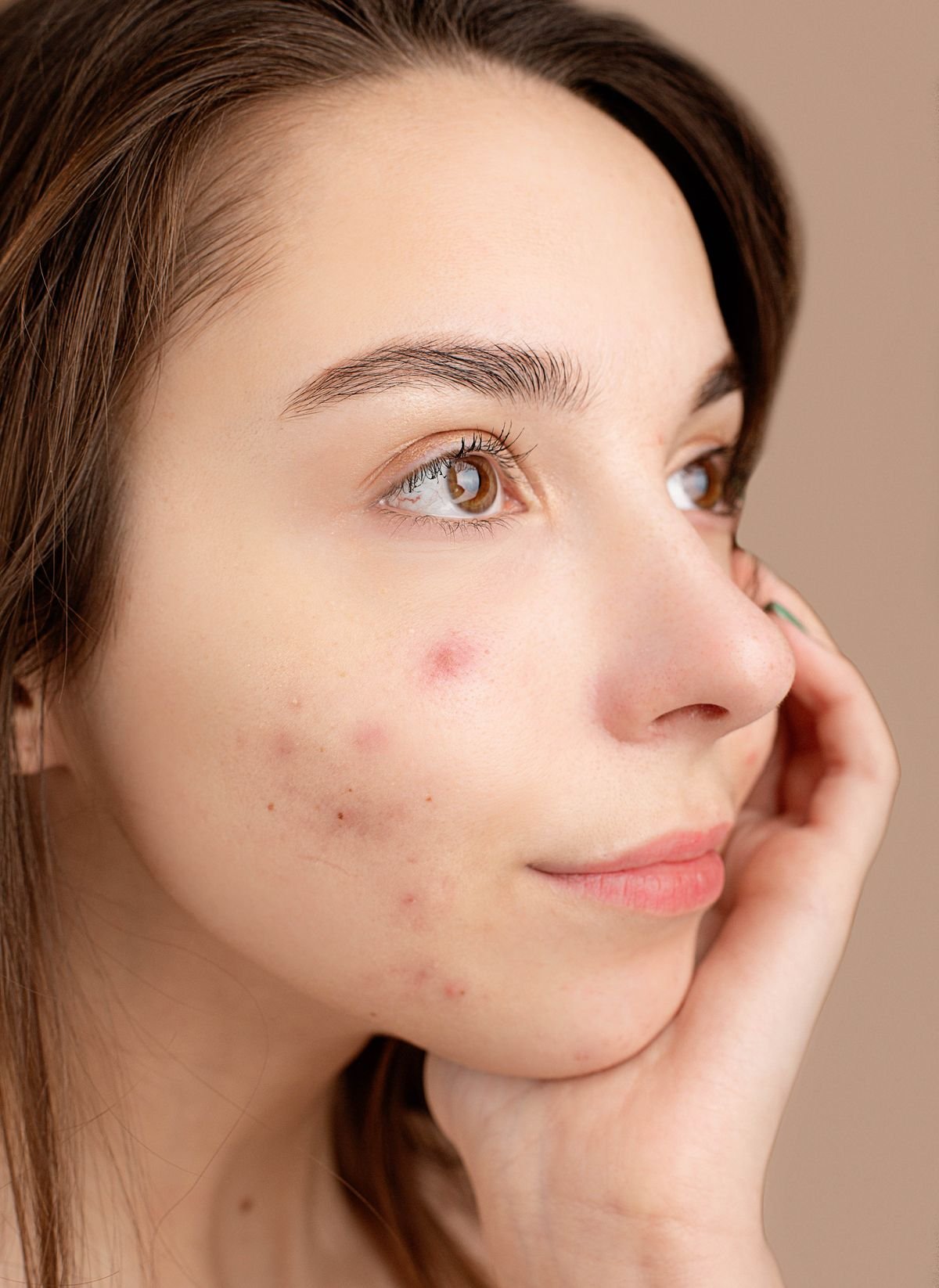 Professional Acne Treatment Program